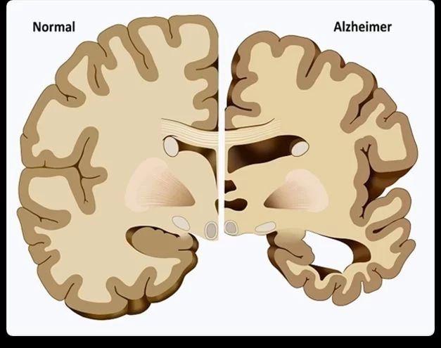 alzheimer antes y despues