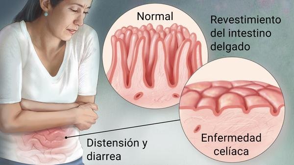 Vivir con celiaquía: hábitos y cuidados para una alimentación segura 61 celiaquia 2