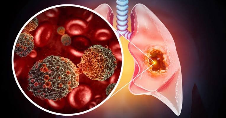 Cáncer a medida: cómo la medicina de precisión cambia el tratamiento y por qué no llega a todos 60 medicina precision cancer
